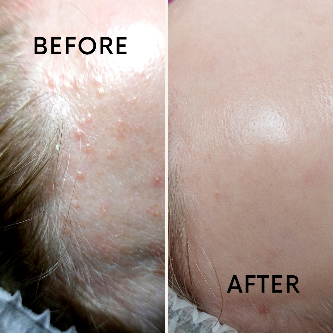 TOP DERM TRANSFORM 1 - 5%  - 30ml