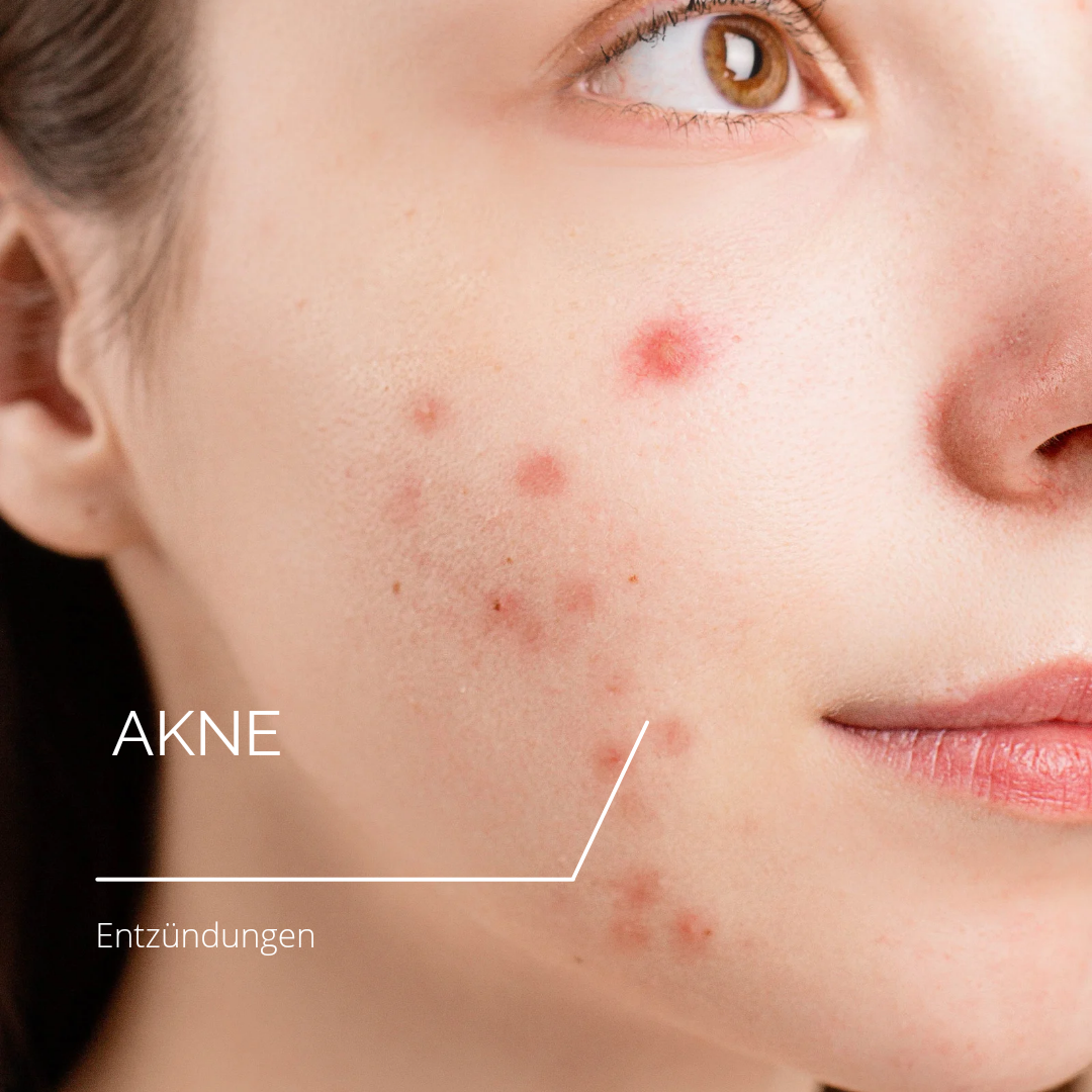 AKNE SPOT SET - 150ml + 150ml + 100g + 30ml