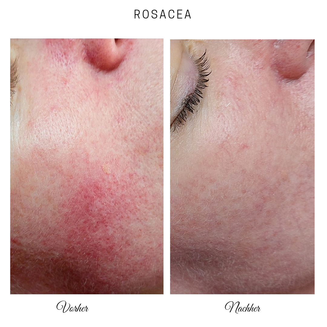 ANTI REDNESS CREME - 50 ML