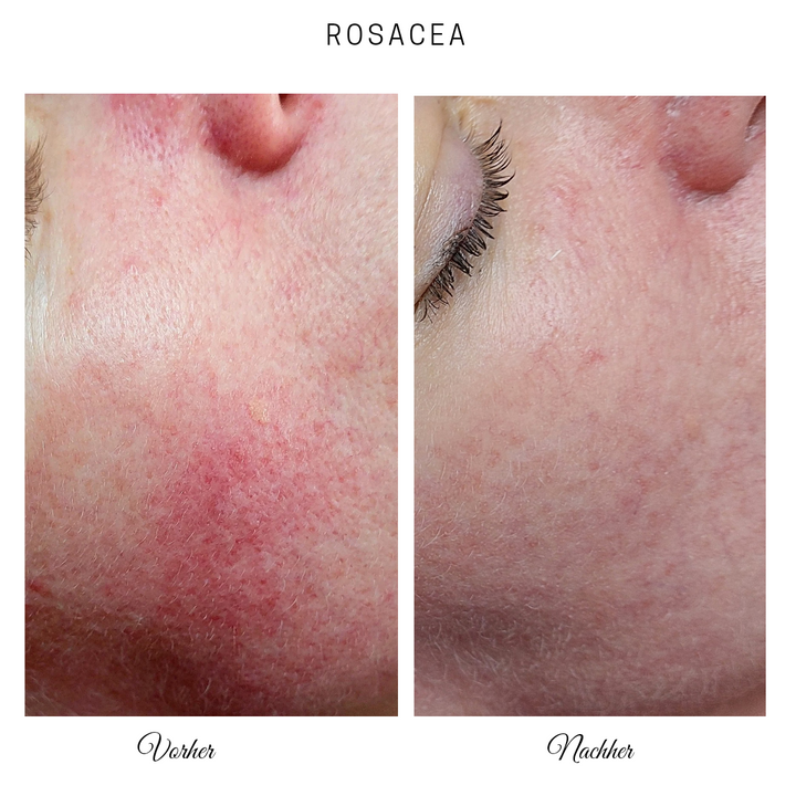 ANTI REDNESS CREME - 50 ML